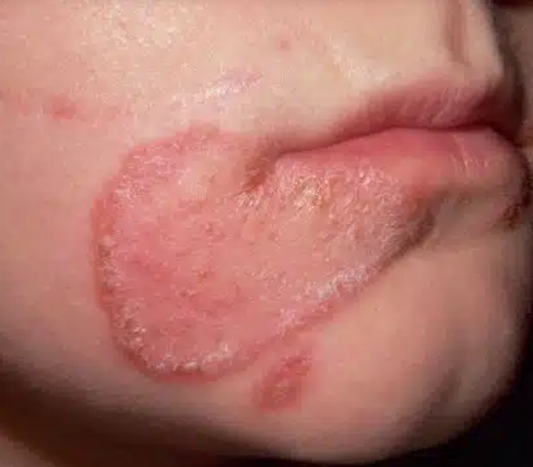 🦠 Can Ringworm Live on Mats?